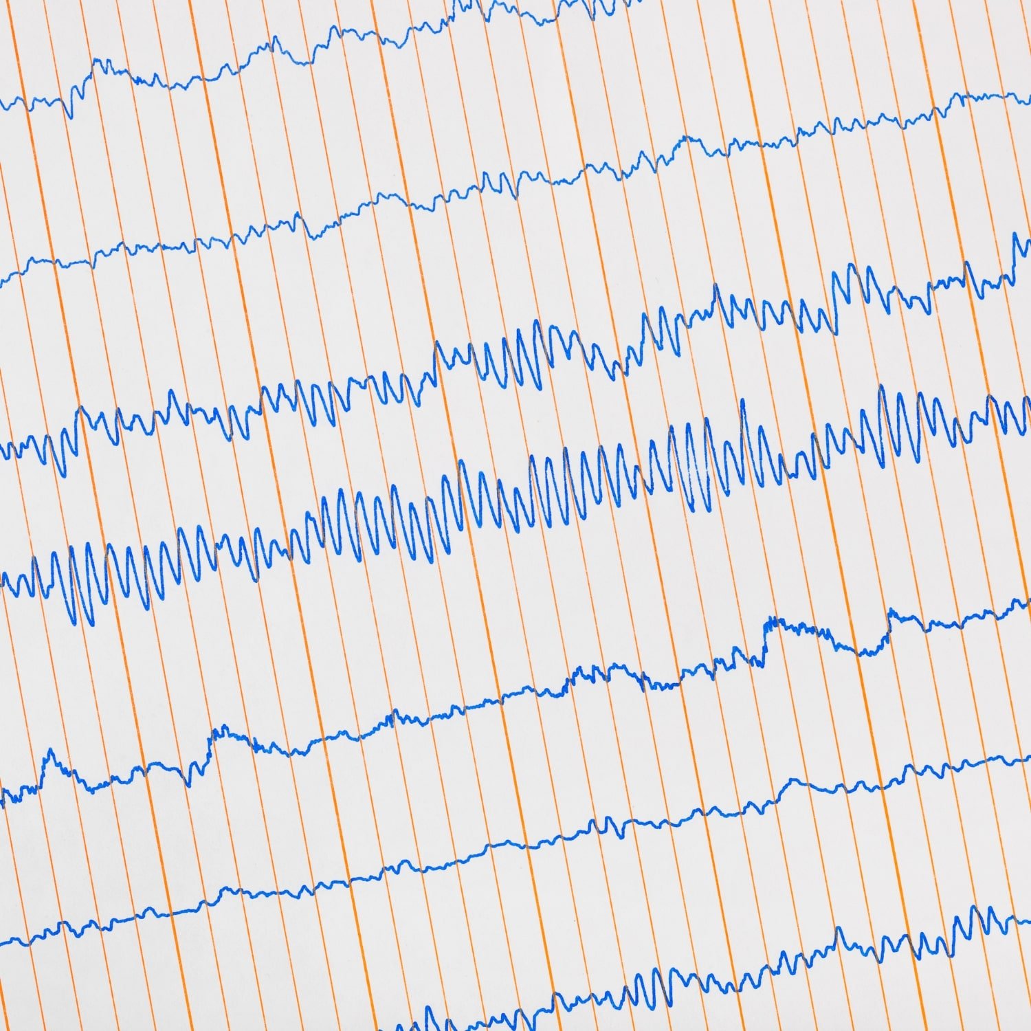 Electrocardiogram (ECG)